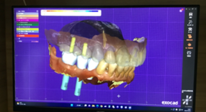 高精度技工物設計システム