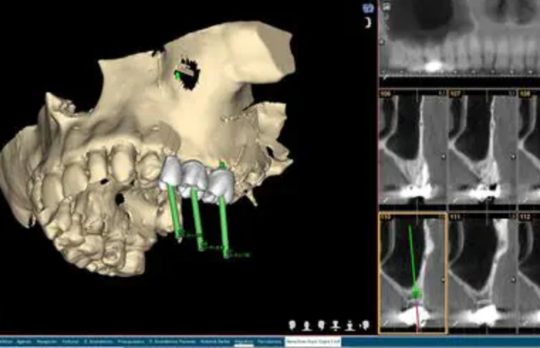 インプラントのメリット