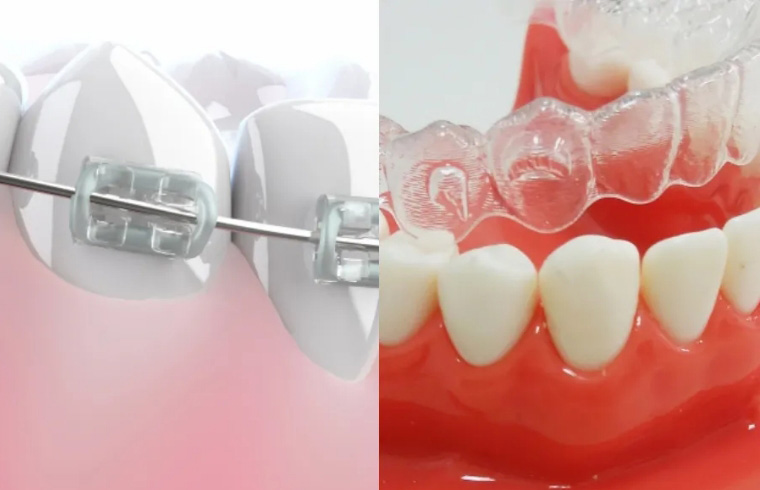 マウスピースとワイヤーの選択が可能